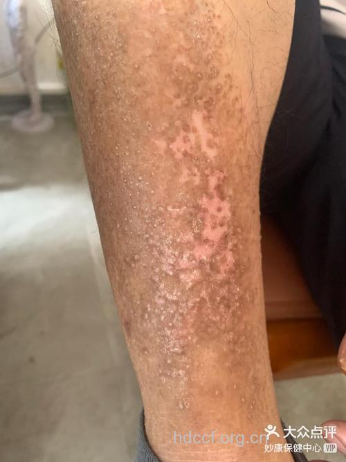 怀孕前后牛皮癣有什么变化