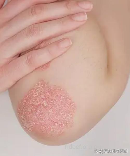 关节病型牛皮癣患者不要小看环境因素的影响