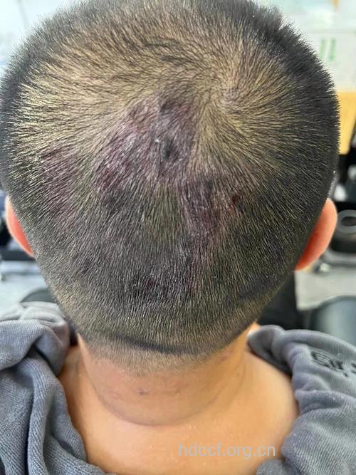 头部牛皮癣皮损的特点