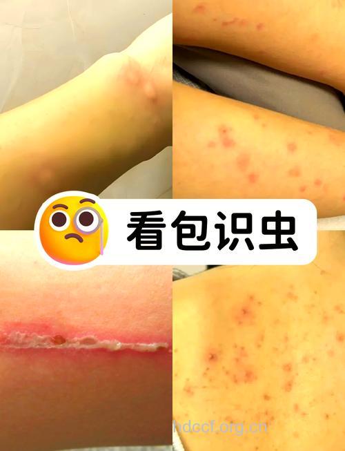 被虫咬乱敷药小心变癌症