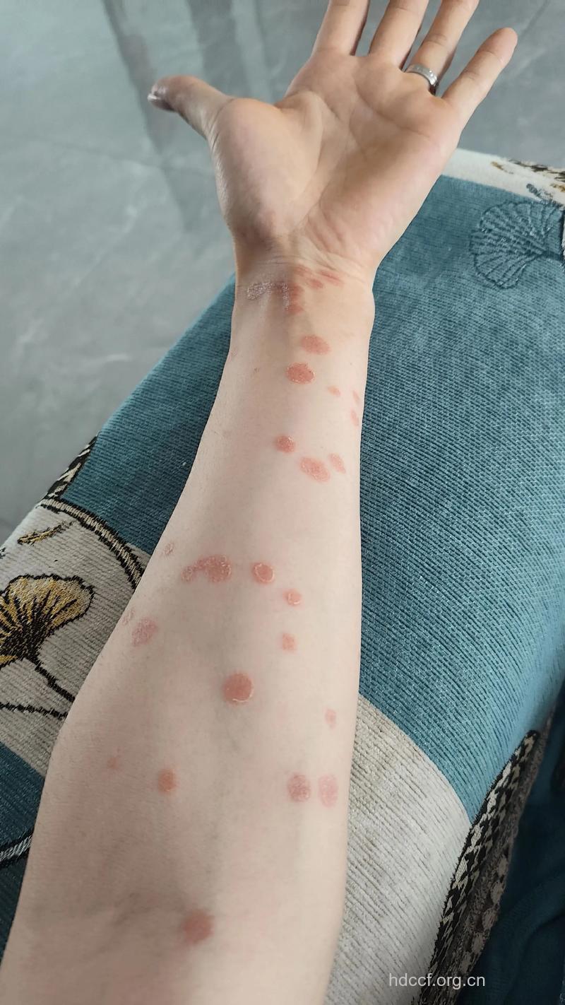 牛皮癣患者洗澡事宜