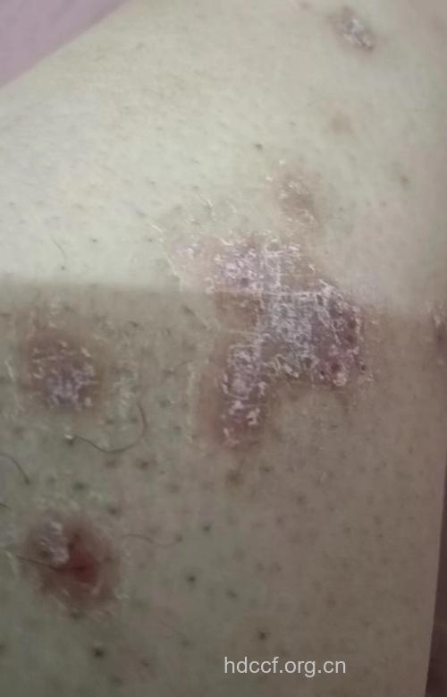 微生物污染引起牛皮癣