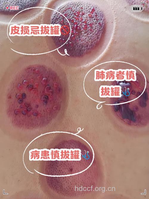 拔罐的常见误区你还在犯吗