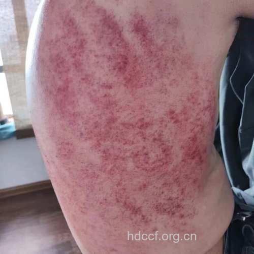刮痧能治糖尿病吗 糖尿病的刮痧疗法