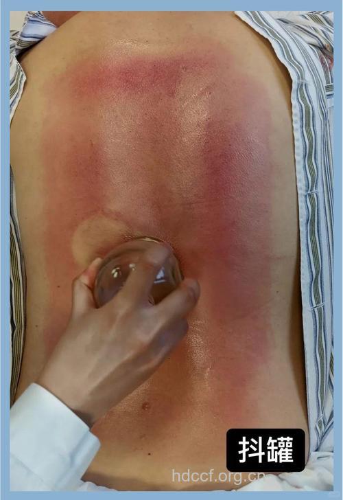 久坐容易腰痛 拔罐能治疗腰痛