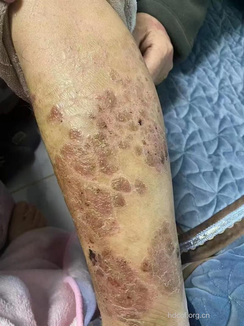 外伤在一定条件下会引发牛皮癣