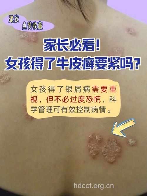 免疫功能紊乱可引发牛皮癣