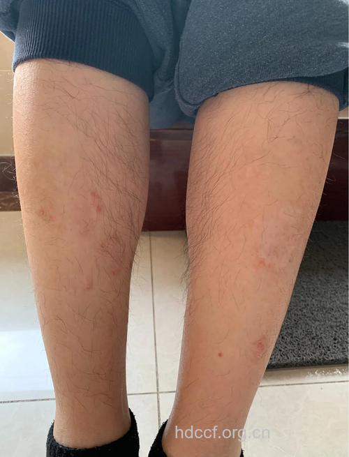 牛皮癣患者穿衣方面的要求