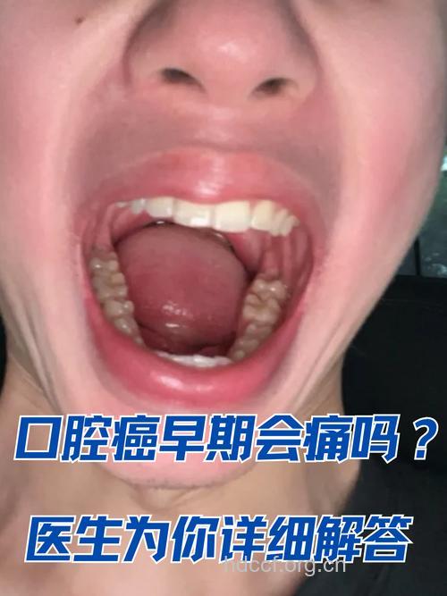 含酒精漱口水会导致口腔癌