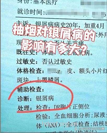 吸烟对牛皮癣患者的伤害