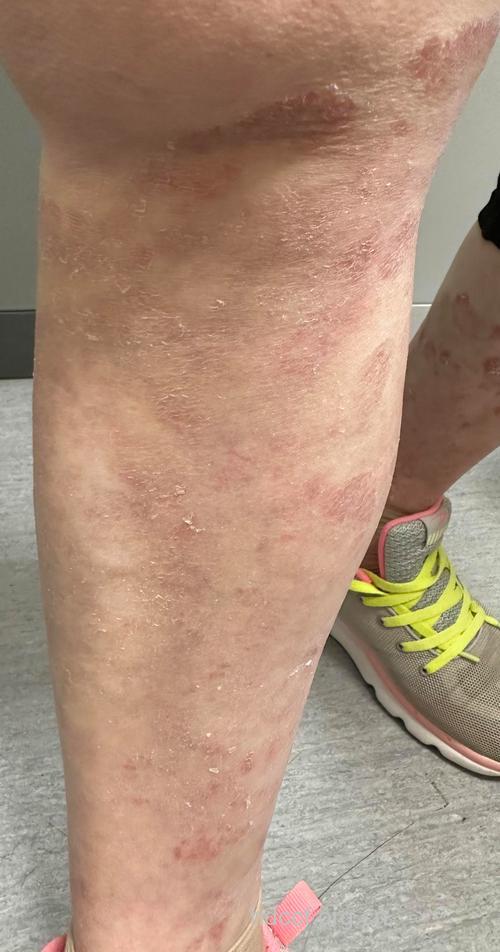 牛皮癣给患者带来一系列身体损害