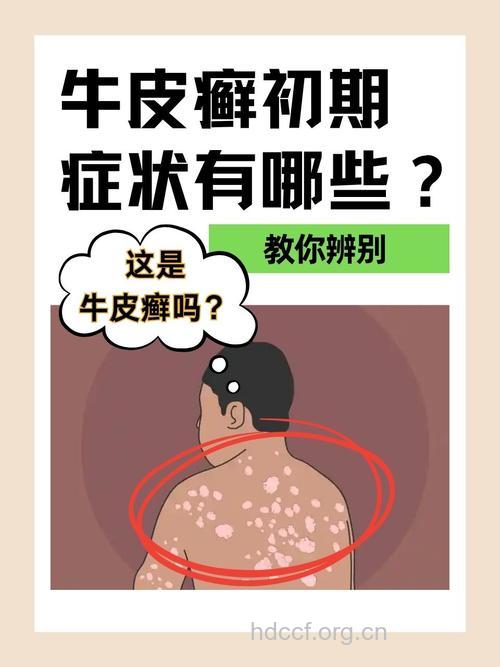 牛皮癣与电脑辐射有关