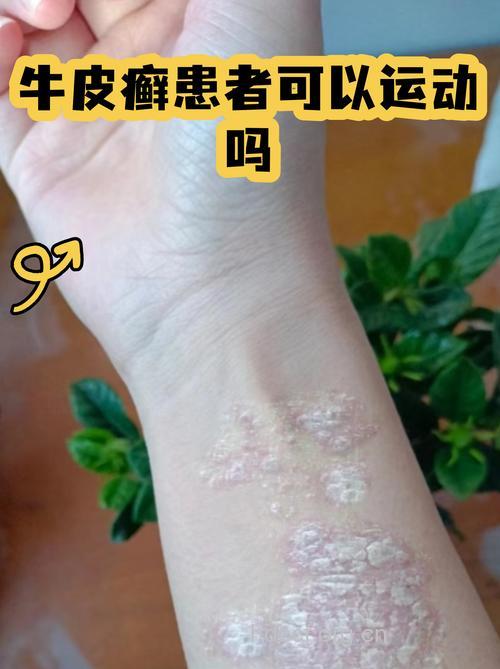 牛皮癣患者健身的好处