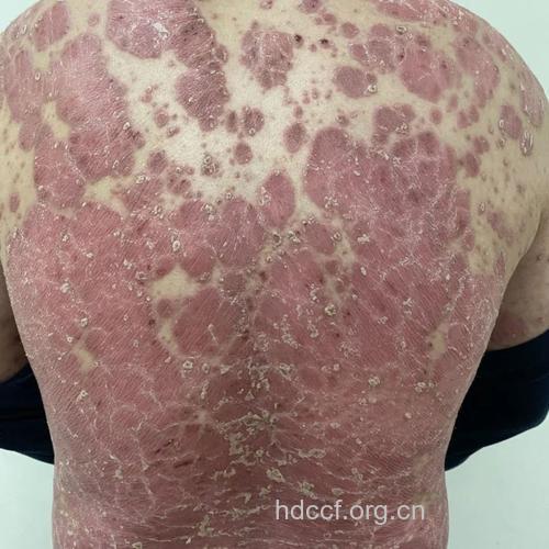 白细胞变异会引起牛皮癣发病