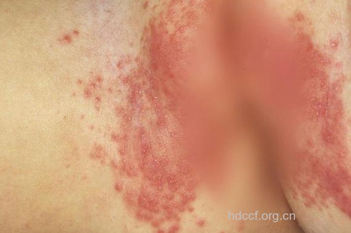 使用尿布可能会诱发婴儿尿布型牛皮癣