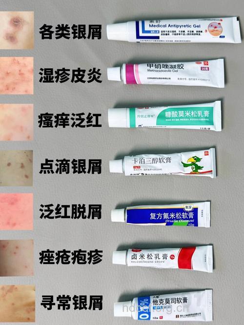 治疗牛皮癣的常见外用药