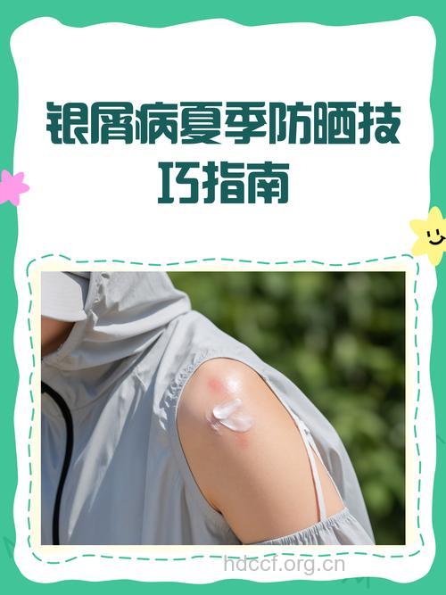 夏季牛皮癣患者注意防晒