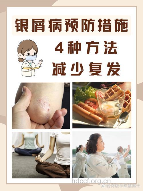 牛皮癣患者避免精神压力过大