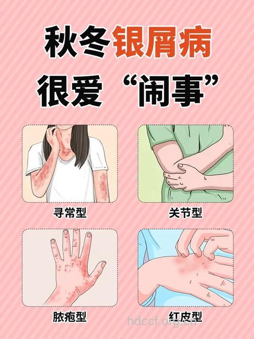 谨防上呼吸道感染引发牛皮癣