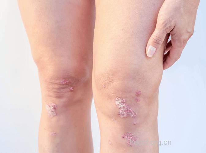 关节病型牛皮癣患者坚持运动