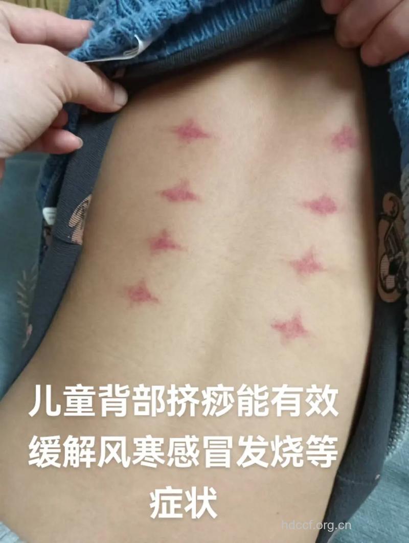 儿童能刮痧吗 专家：可以