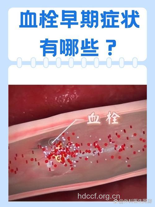 血栓是癌症的前兆吗