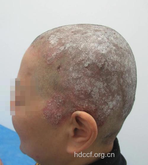 牛皮癣各类型之间的转化