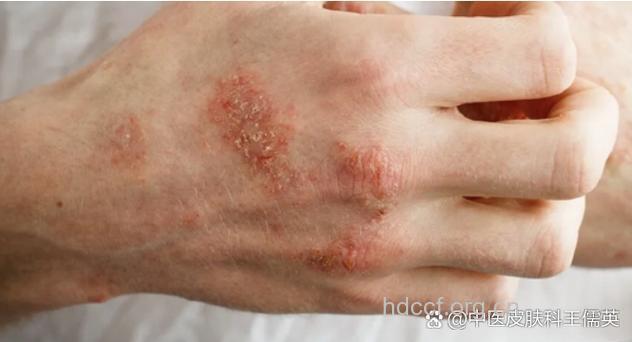 牛皮癣患者最好不要纹身