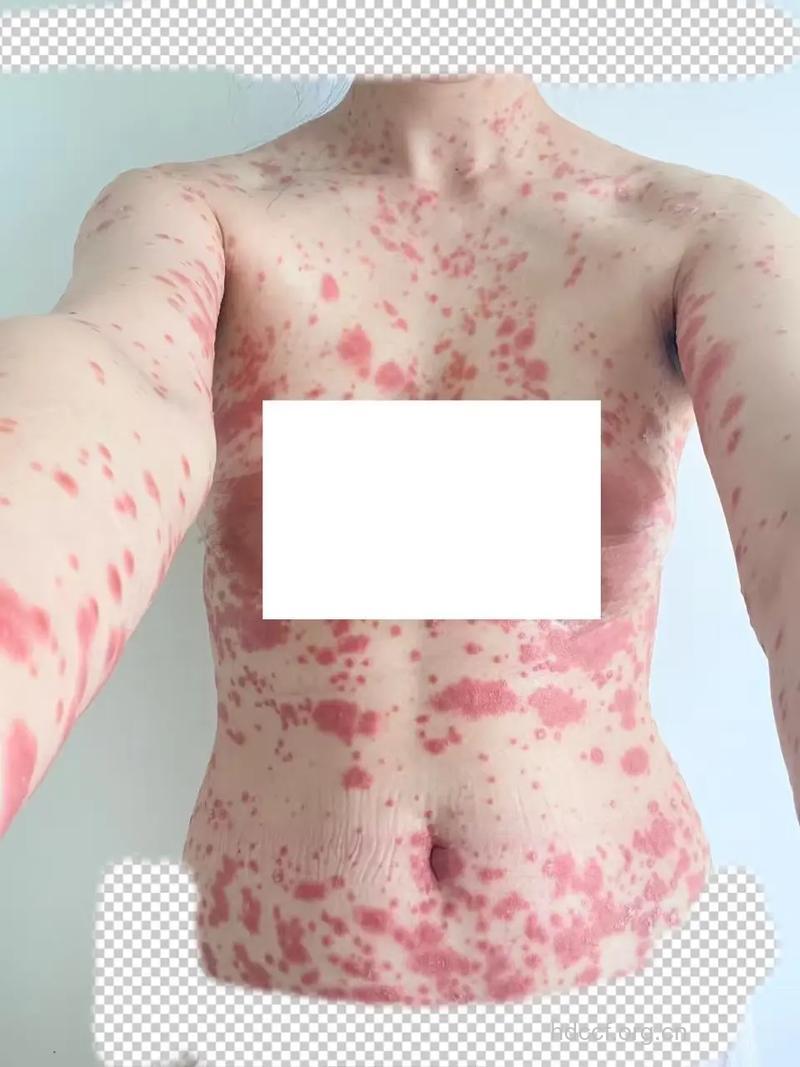 牛皮癣感染后的危害