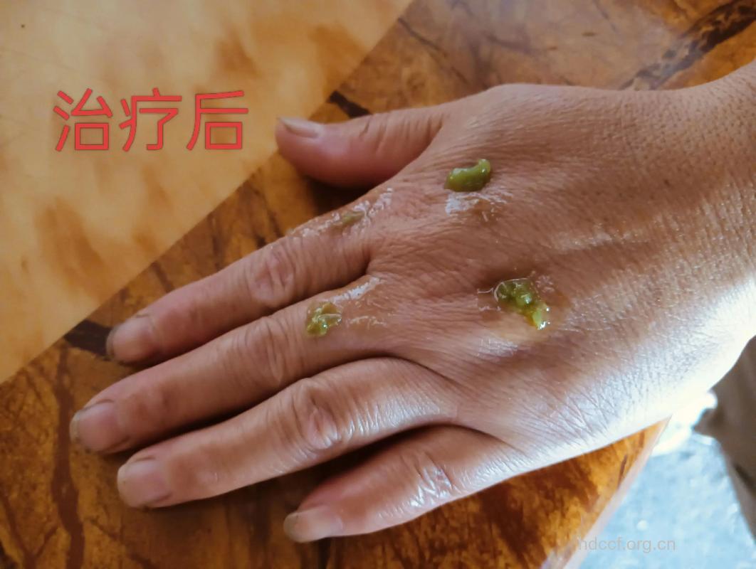 中医药治疗牛皮癣的弊端