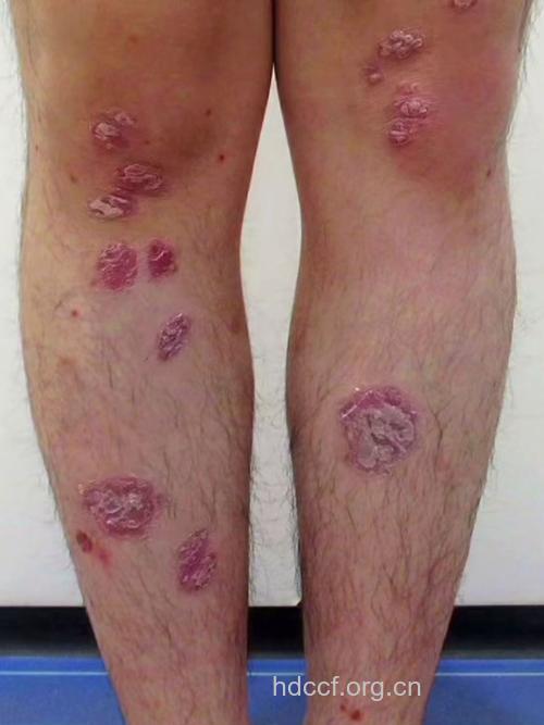 牛皮癣究竟牛不牛？