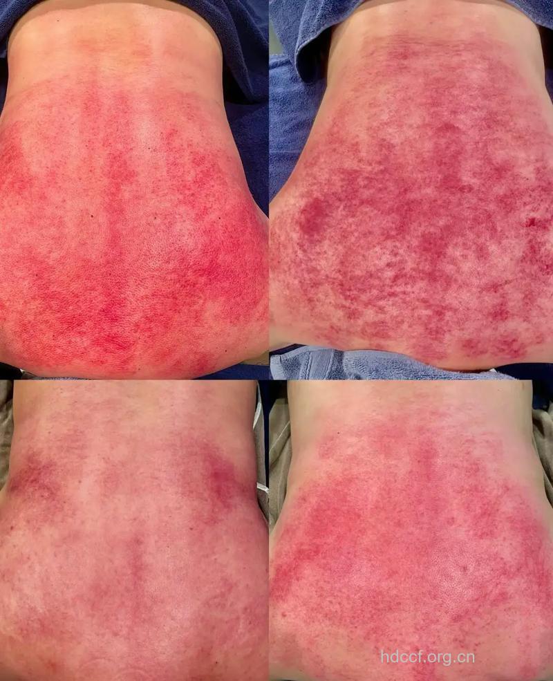 背部刮痧后皮肤发紫是为什么