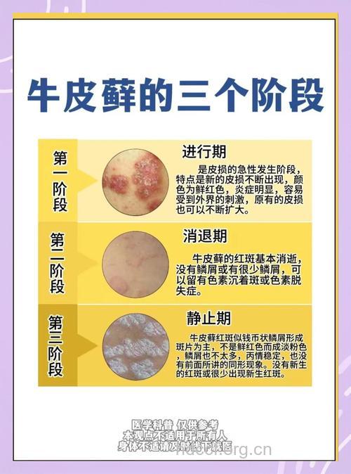 牛皮癣的病程