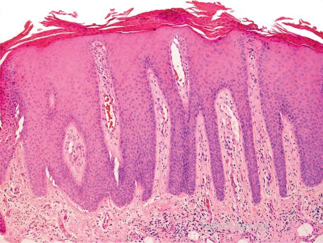 牛皮癣病理是什么？