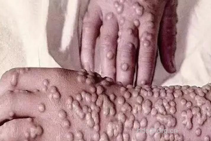 什么是天花？天花的症状？