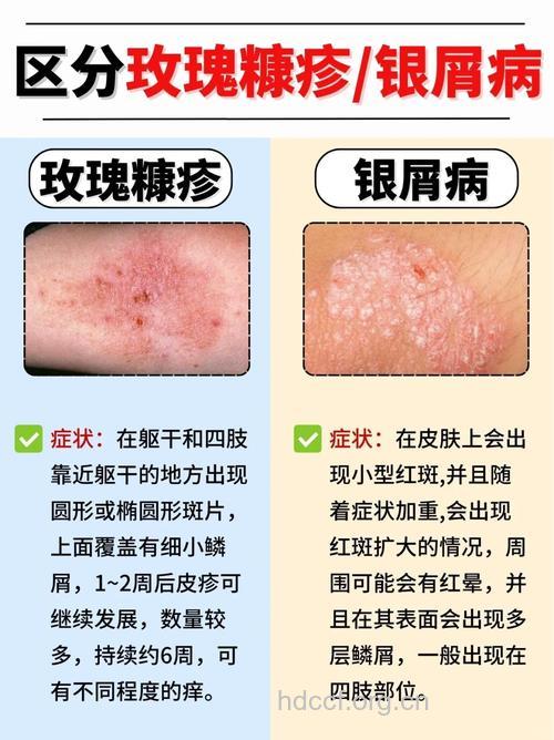 容易与银屑病混淆的疾病