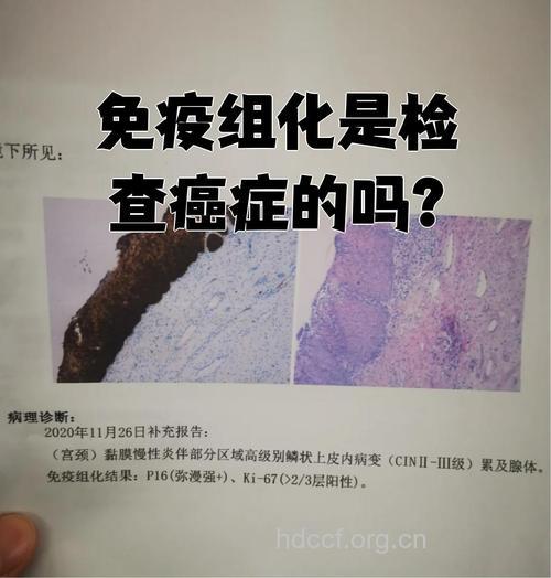 肿瘤一定要做免疫学检查吗