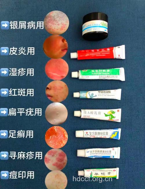 网友分享银屑病治疗经验