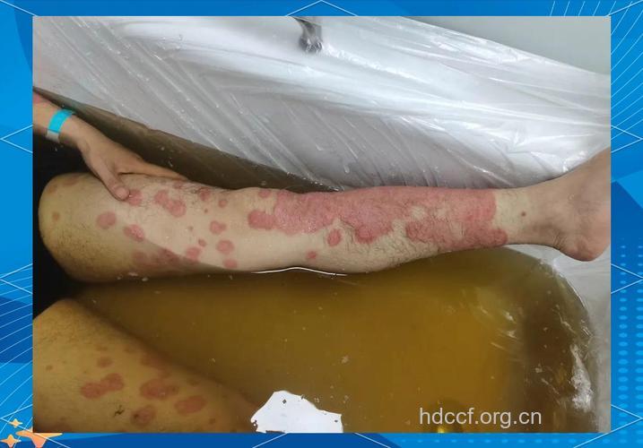 桑拿浴让银屑病患者皮肤“呼吸”