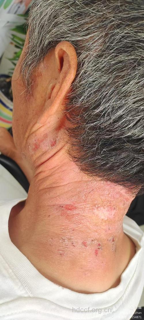 夏季 神经性皮炎高发期