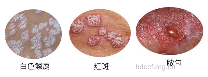 扁桃体炎 银屑病的隐患