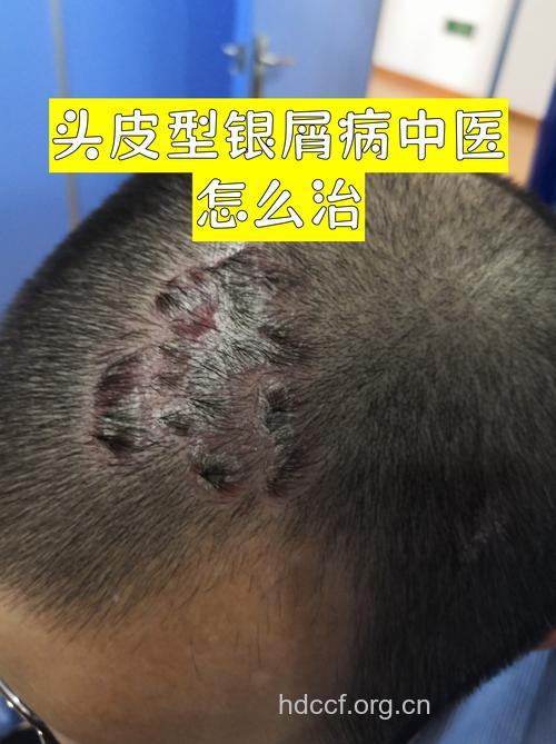 你听说过头皮型银屑病吗?