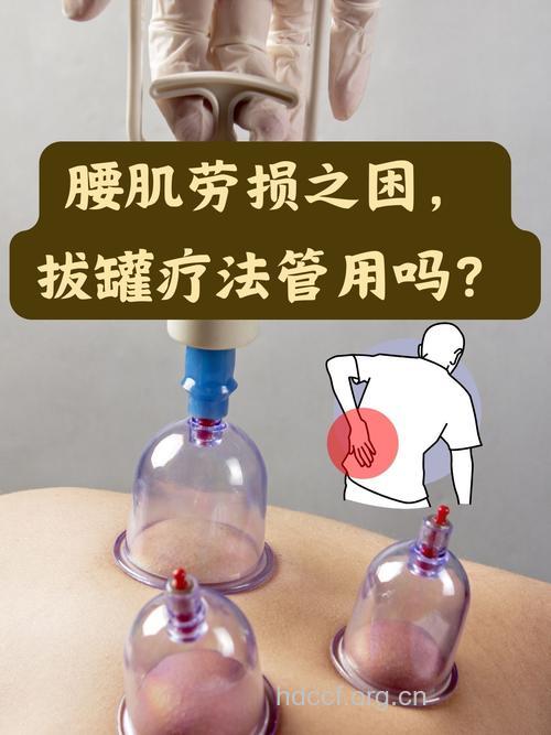 腰部可以拔火罐吗 腰部拔罐可治疗腰肌劳损