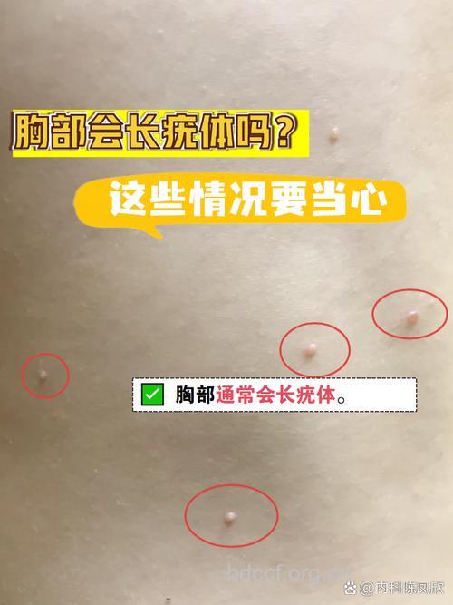 当心洗澡洗出传染性软疣