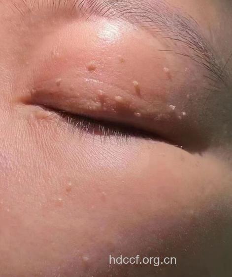 祛眼部扁平疣的偏方与注意事项