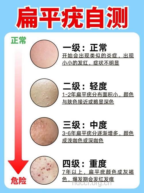 扁平疣都有哪些危害