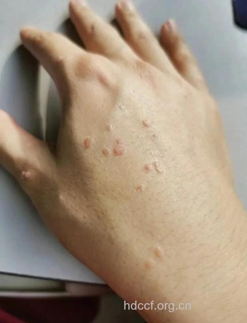 扁平疣常见症状图片