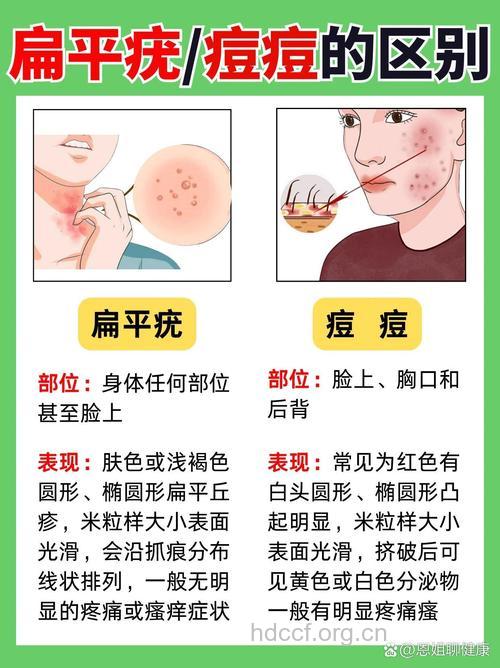 扁平疣与青春痘的关系