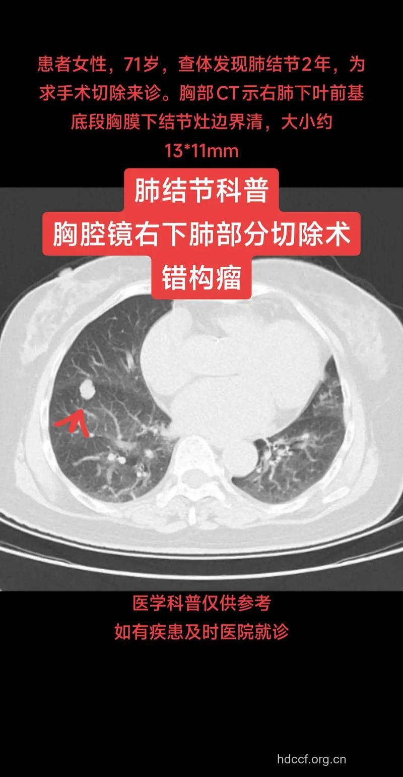 面面观 肺错构瘤的诊治