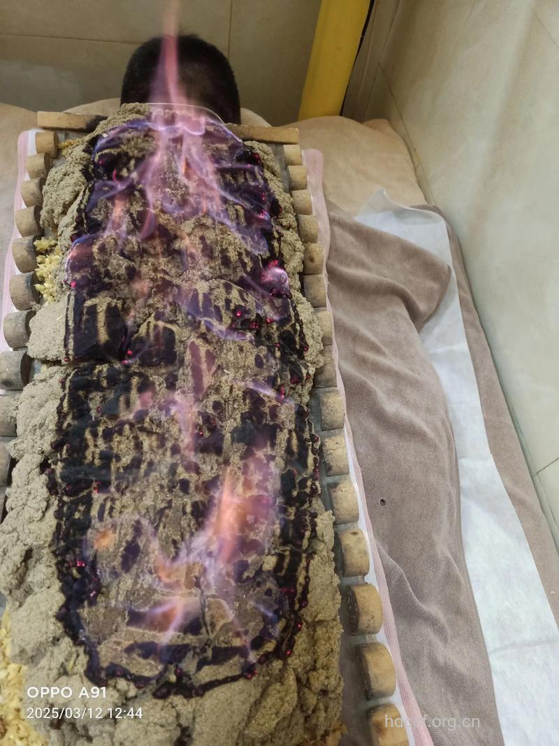 春季养生可以尝试火龙灸